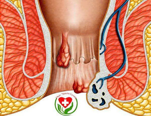 Mạch Lươn (Rò Hậu Môn): Dấu Hiệu Và Cách Điều Trị Từ A-Z Mạch Lươn (Rò Hậu Môn): Dấu Hiệu Và Cách Điều Trị Từ A-Z